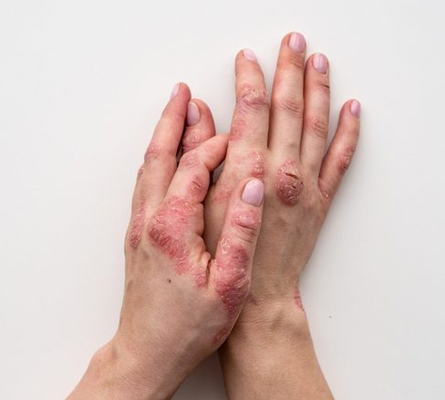 Read more about the article Psoriasis