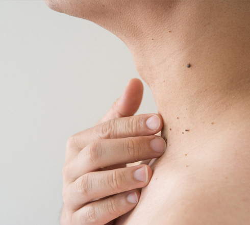 Read more about the article Skin tag and wart removal