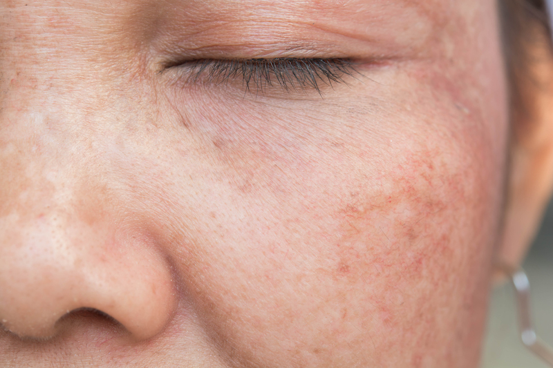 Read more about the article Age spots and sun damage