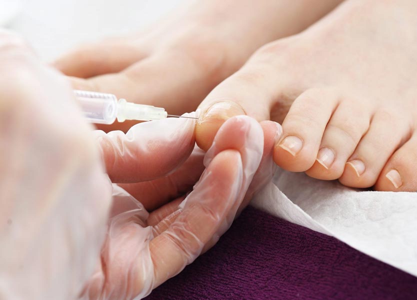 Read more about the article Ingrown nail surgery