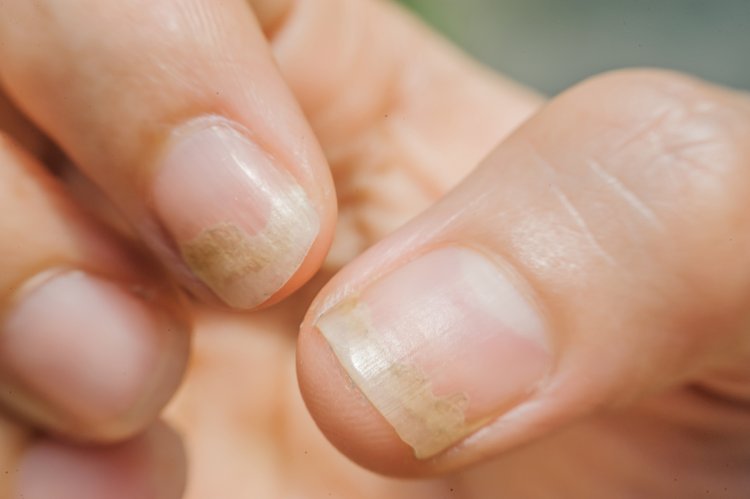 Read more about the article Nail conditions