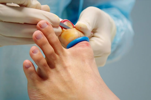 Nail surgery In Singapore - Stratum Skin and Surgery