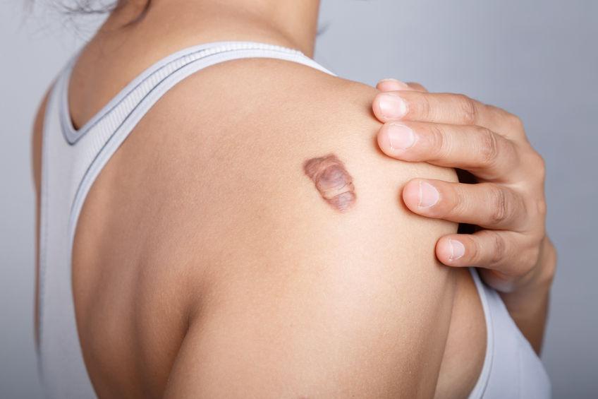 Read more about the article Scars and keloid