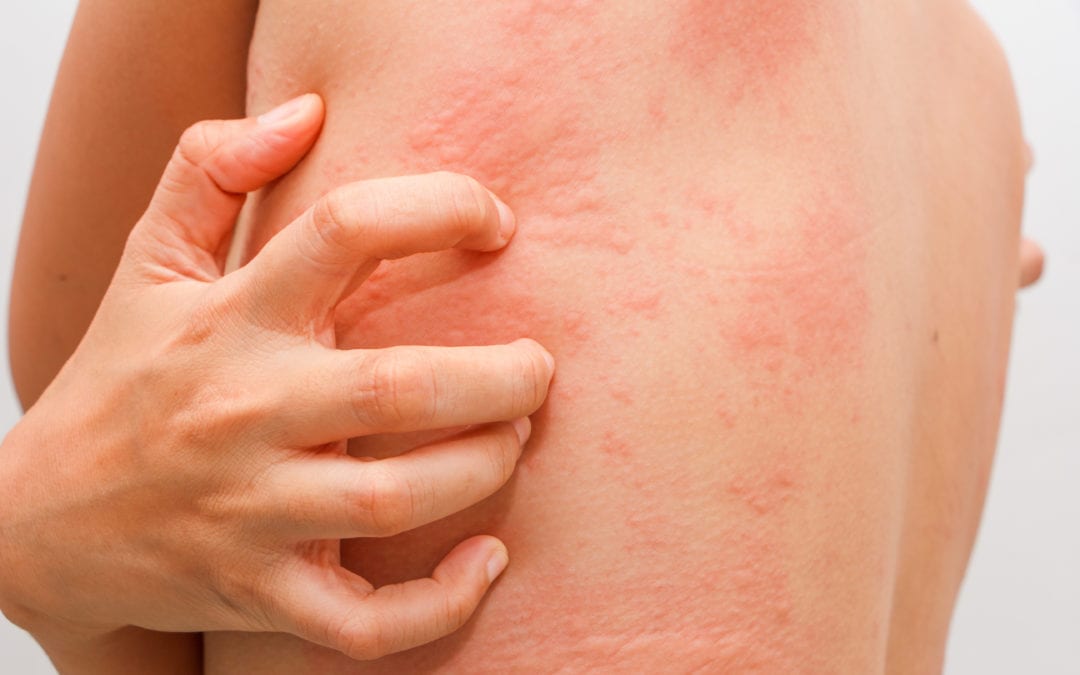 Read more about the article Skin allergies