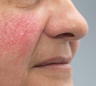 SPIDER VEINS & ROSACEA