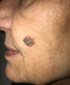 Seborrheic keratosis removal