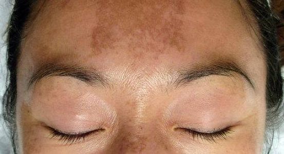 Sun Damage and pre-cancerous skin growths